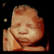 3d ultrasound, 4d ultrasound